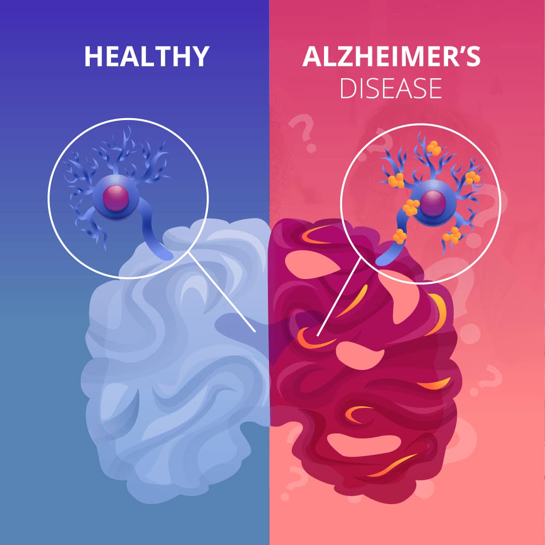 Explain the benefits of resveratrol extracted from mulberry to alzheimer's disease.