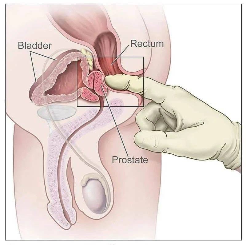 ภาวะต่อมลูกหมากโต (enlarged prostate หรือ benign prostatic hyperplasia, BPH) เป็นอาการทั่วไปที่ส่งผลต่อผู้ชายเมื่ออาย...